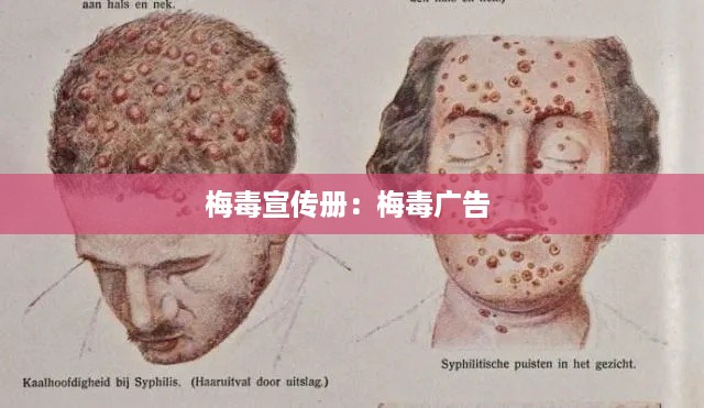 梅毒宣传册：梅毒广告 