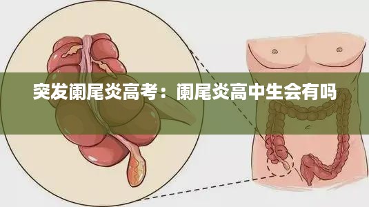 突发阑尾炎高考:阑尾炎高中生会有吗