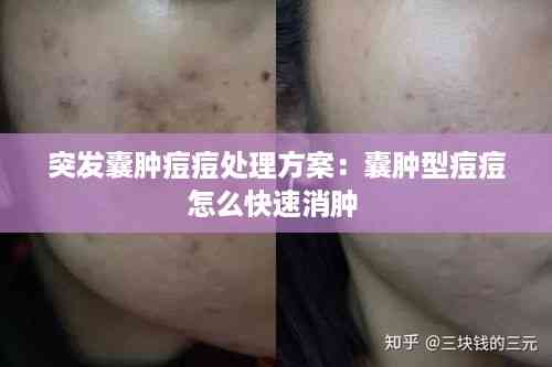 突发囊肿痘痘处理方案:囊肿型痘痘怎么快速消肿