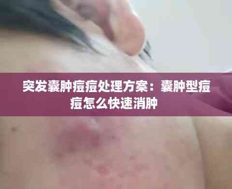 突发囊肿痘痘处理方案:囊肿型痘痘怎么快速消肿